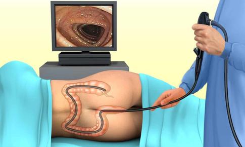 Trước và sau khi nội soi đại tràng cần lưu ý gì?