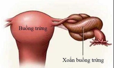 Đau bụng dữ dội, buồn nôn phát hiện xoắn u nang buồng trứng