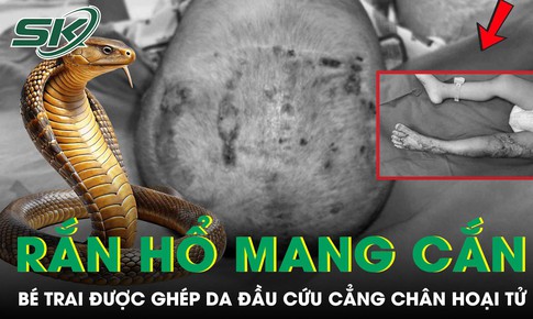 Bé trai thoát cảnh cắt cụt chân nhờ ghép da đầu sau khi bị rắn hổ mang cắn