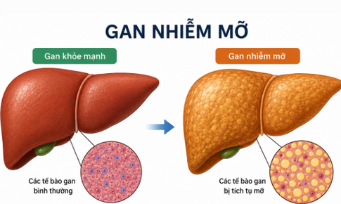 Cách chữa gan nhiễm mỡ độ 1 không dùng thuốc