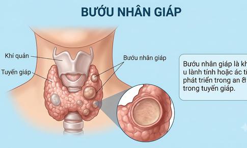Bướu nhân tuyến giáp, nên mổ hay đốt sóng cao tần?