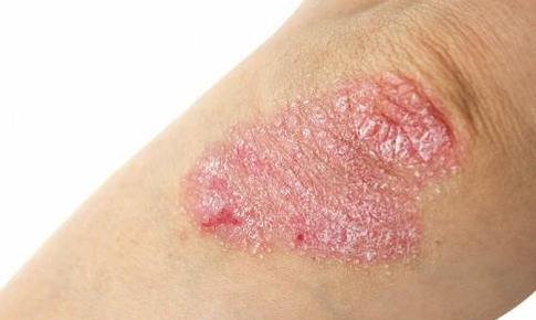 Cách chăm sóc da hàng ngày với người bệnh vảy nến để kiểm soát bệnh hiệu quả