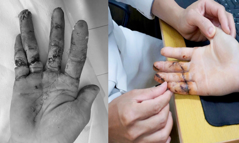 Ngày đầu đi làm, thanh niên 17 tuổi suýt mất 3 ngón tay vì máy cưa