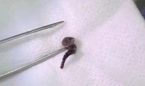 Uống nước ở suối, nam thanh niên bị con đỉa dài 2,5cm chui vào mũi