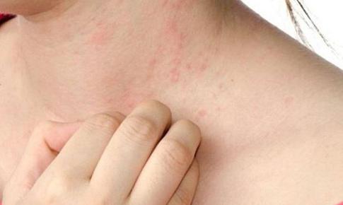 Ngứa, nổi mề đay có phải là triệu chứng sớm của bệnh gan?