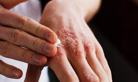 Cần làm gì khi nghi ngờ bị viêm da tiếp xúc?