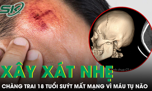 Chỉ xây xát nhẹ sau tai nạn, chàng trai 18 tuổi suýt mất mạng vì tụ máu não