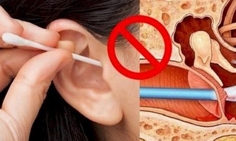Ráy tai có cần lấy thường xuyên?