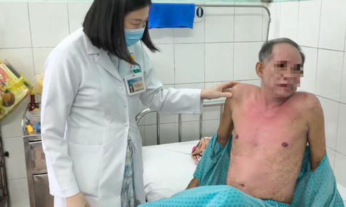 Dị ứng thuốc nhỏ mắt, người đàn ông bị hoại tử thượng bì nhiễm độc nguy kịch