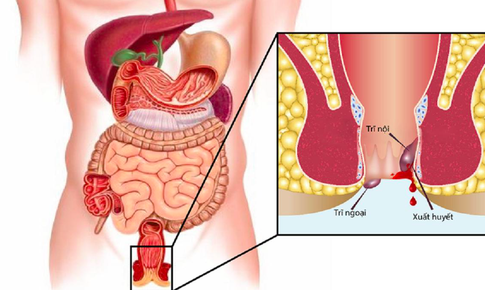 6 sai lầm khiến nhiều người điều trị trĩ thất bại