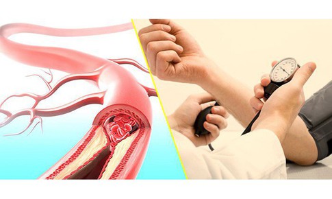 Có phải cứ chóng mặt là do cao huyết áp?