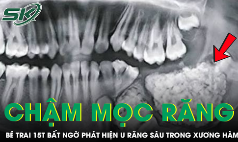 Răng nanh chậm mọc, bé trai bất ngờ phát hiện u răng sâu trong xương hàm