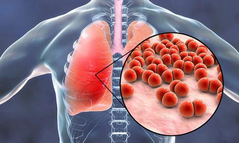 Viêm phổi ở người già có lây không?