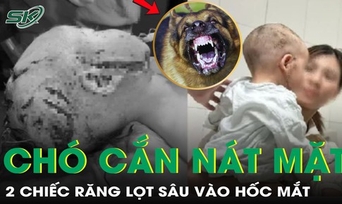 Bé trai 2 tuổi bị chó cắn nát vùng mặt