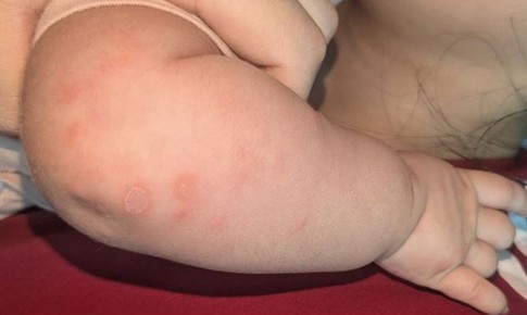 Bé gái 2 tháng tuổi mắc giang mai, nguy cơ nghiêm trọng nếu không được phát hiện