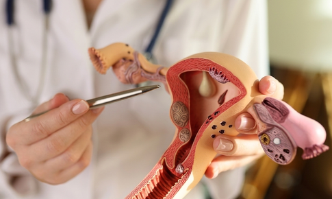 Polyp nội mạc tử cung có nguy hiểm không?