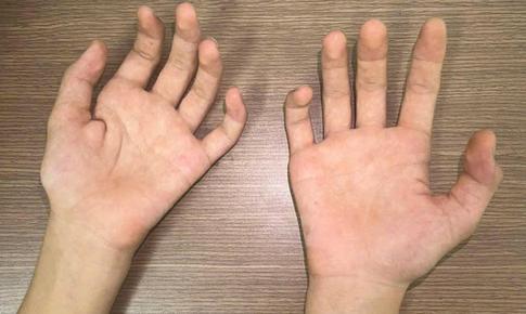 Teo cơ bàn tay ở người trẻ: Cảnh giác với bệnh Hirayama hiếm gặp