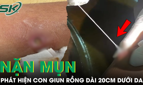 Phát hiện con giun rồng dài 20cm dưới da khi đang tự nặn mụn