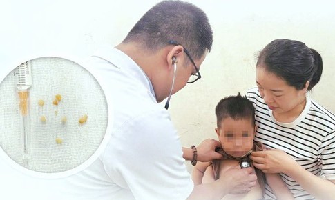 Cứu sống bé trai 2 tuổi hóc hạt lạc, bít kín hai bên phế quản
