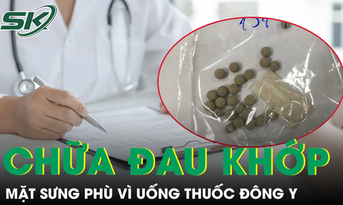 Mặt sưng phù vì uống thuốc đông y chữa đau khớp