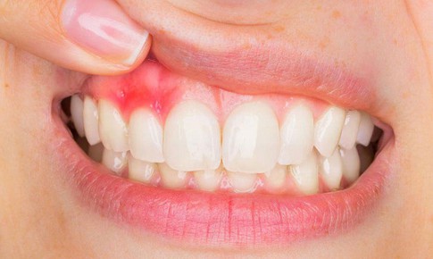 Viêm lợi sau khi bọc răng sứ phải làm gì?