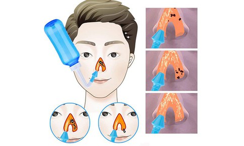 Vệ sinh mũi đúng cách