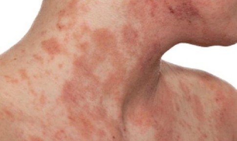 Phân biệt viêm da cơ địa với các bệnh da khác
