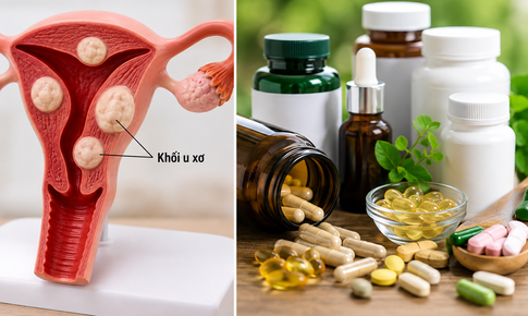Người bệnh u xơ tử cung nên thận trọng với những thực phẩm chức năng nào?