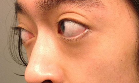 Lồi mắt Basedow cần làm gì?
