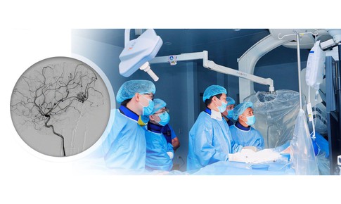Hai trẻ vỡ dị dạng mạch máu não được can thiệp nội mạch thành công