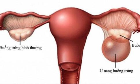 U nang buồng trứng ác tính có chữa được không?