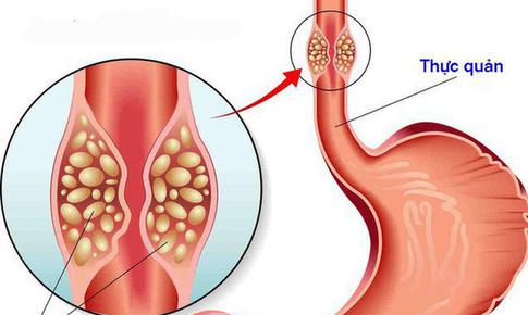 Triệu chứng hẹp thực quản: Đừng chủ quan khi thường xuyên nuốt nghẹn