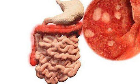 Viêm ruột có nguy hiểm không?