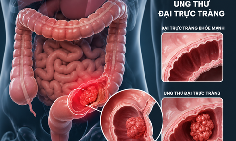Chế độ ăn có làm tăng nguy cơ ung thư đại trực tràng?