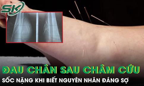 Đau chân dữ dội sau châm cứu, người phụ nữ sốc nặng khi biết nguyên nhân