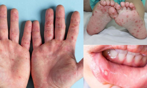 Sốt xuất huyết, tay chân miệng diễn biến phức tạp, Lâm Đồng khẩn cấp phòng dịch