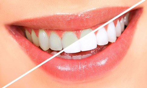 Thói quen xấu làm hại men răng thường gặp