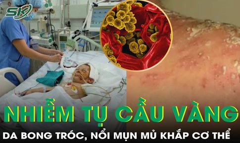 Nhiễm tụ cầu vàng, bé trai 3 tuổi da bong tróc, nổi mụn mủ khắp cơ thể