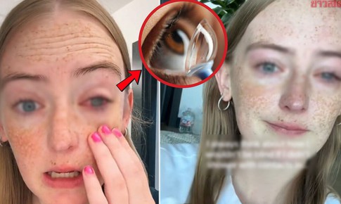 Đeo kính áp tròng khi tắm, cô gái 20 tuổi suýt mù mắt 