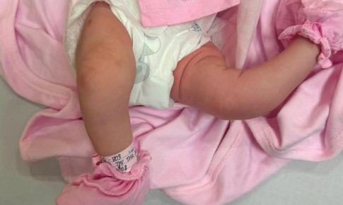 Bệnh viện Nhi Hải Phòng phẫu thuật thành công bé sơ sinh chân 'gập ngược' bất thường