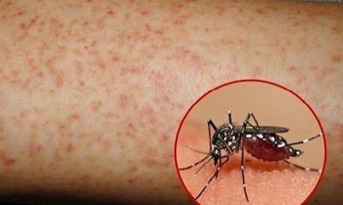 Cô gái tử vong vì sốt xuất huyết, cảnh báo không chủ quan biến chứng bệnh