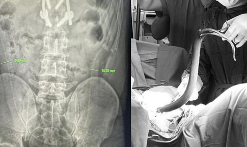 Nhét lươn sống dài nửa mét vào hậu môn, người đàn ông suýt thủng ruột