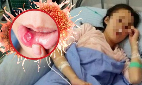 Cô gái 26 tuổi 'chết lặng' phát hiện ung thư giai đoạn 3 khi khám nhiệt miệng