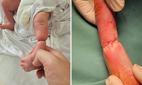 Giải cứu chi cho bé sơ sinh mắc hội chứng dải sợi ối hiếm gặp