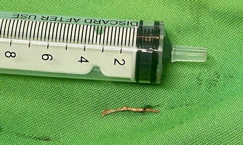 Mắc xương cá, người đàn ông phải cắt bỏ tuyến dưới hàm