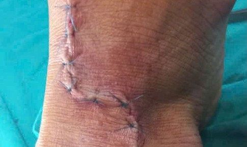 Vết tôn cắt 1cm, bác sĩ phát hiện tổn thương gân nghiêm trọng