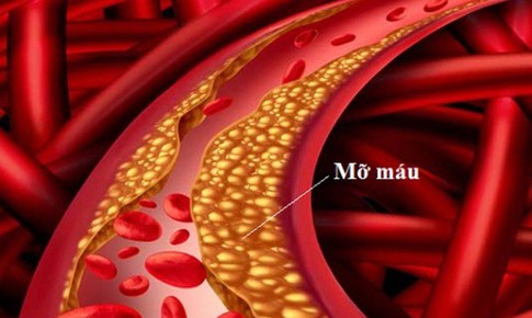 5 lưu ý khi điều trị mỡ máu tại nhà