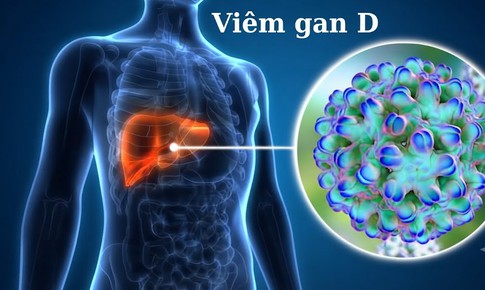 HIV và viêm gan D mạn tính: Vì sao cần đặc biệt lưu ý?