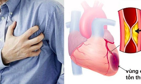 Nhồi máu cơ tim cấp do tắc mạch vành ở người hút thuốc lá nhiều năm