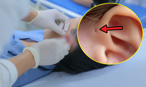 Lỗ nhỏ trước tai khiến cô gái 17 tuổi nhiều năm liên tục viêm nhiễm, áp xe